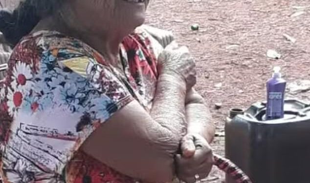 81-year-old Brazilian woman dies after surgery to remove 56-year-old deceased foetus